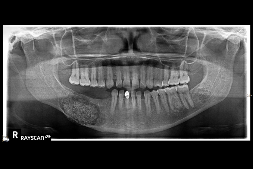 Diagnosis and Treatment of a Large Central Ossifying Fibroma of the Mandible