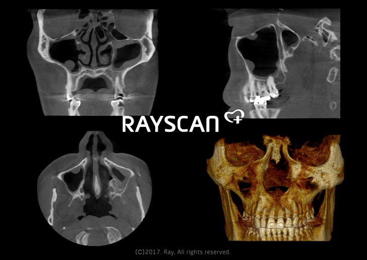 RAYSCAN m+