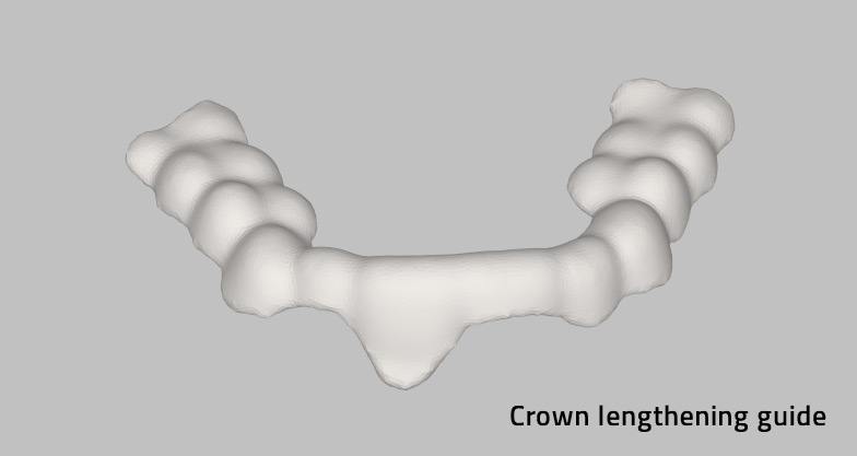 crown lengthening guide